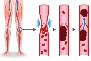 Thrombose: Ursachen, Anzeichen und Behandlung